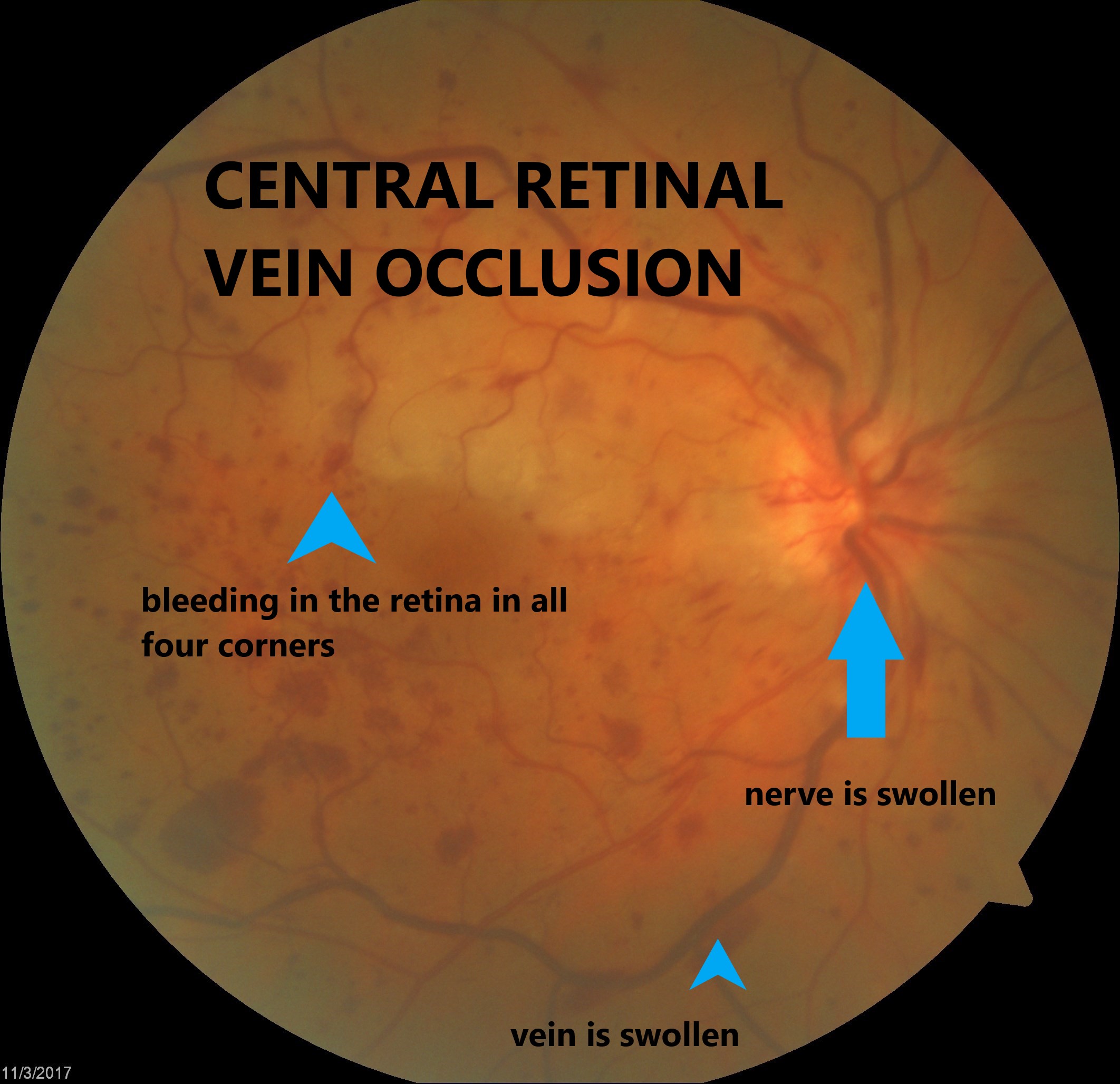 Branch Retinal Vein Occlusion Oct