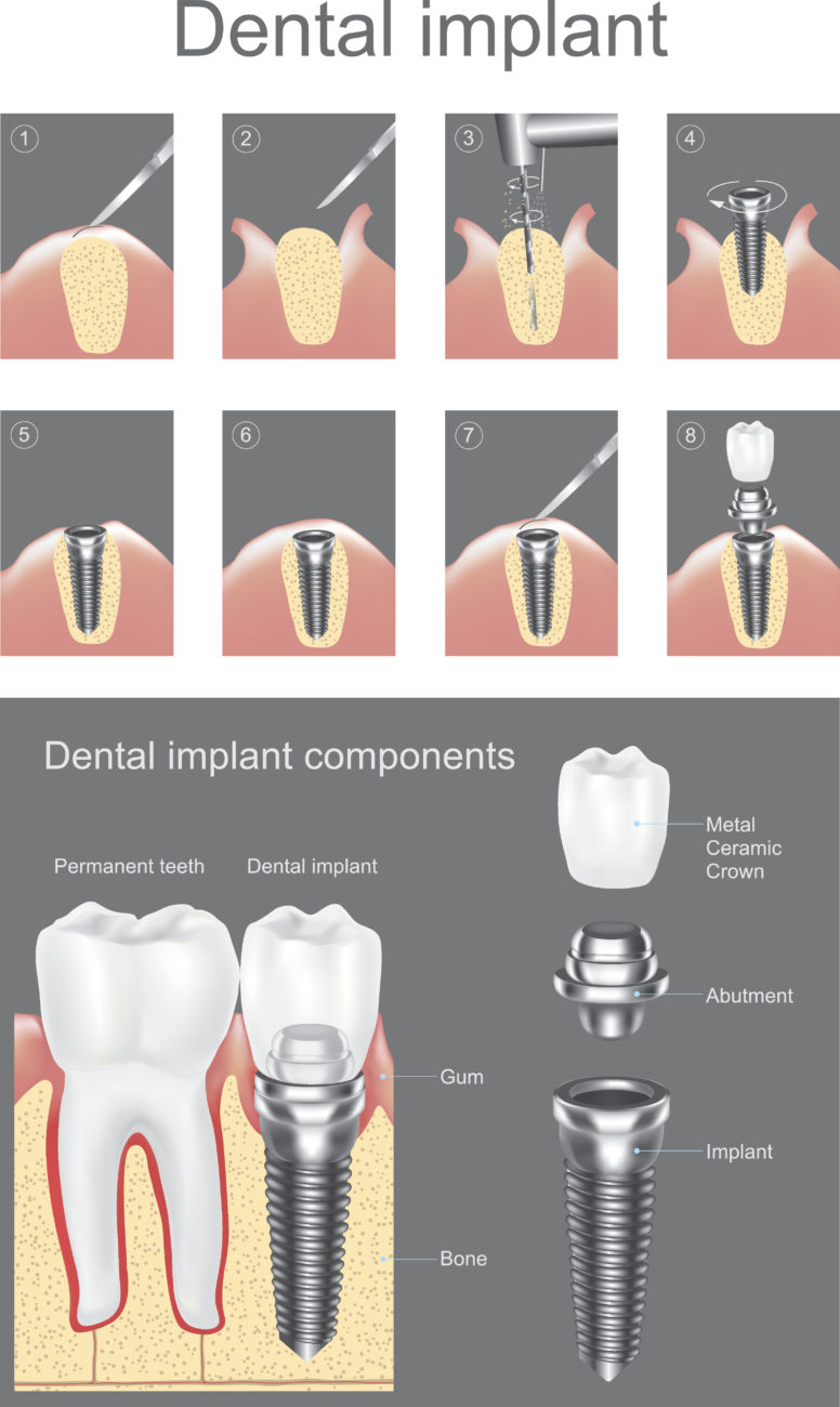 Dental Implants Procedure