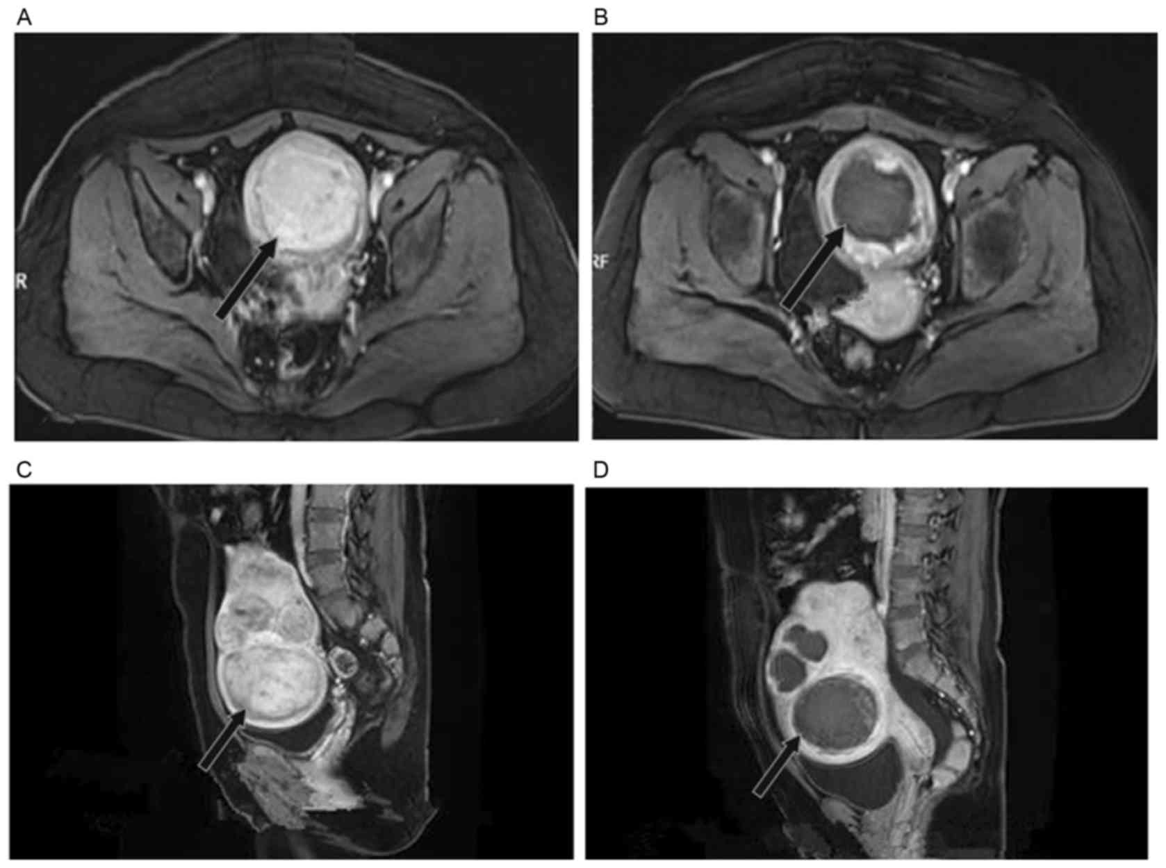 Uterine Fibroids Mri