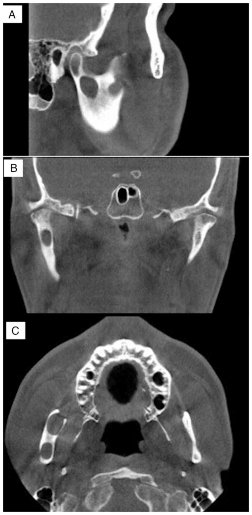 Odontogenic keratocyst in the mandibular condyle base region: A case report