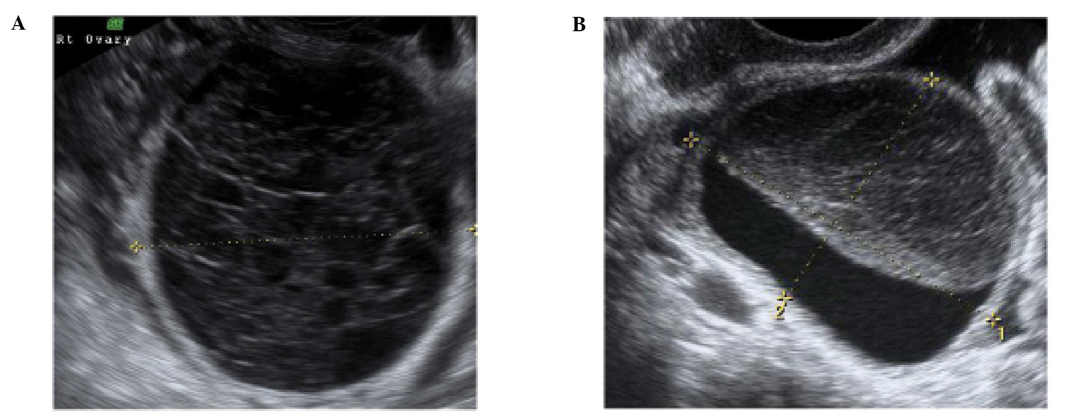 Normal Ovary Cysts Ultrasound