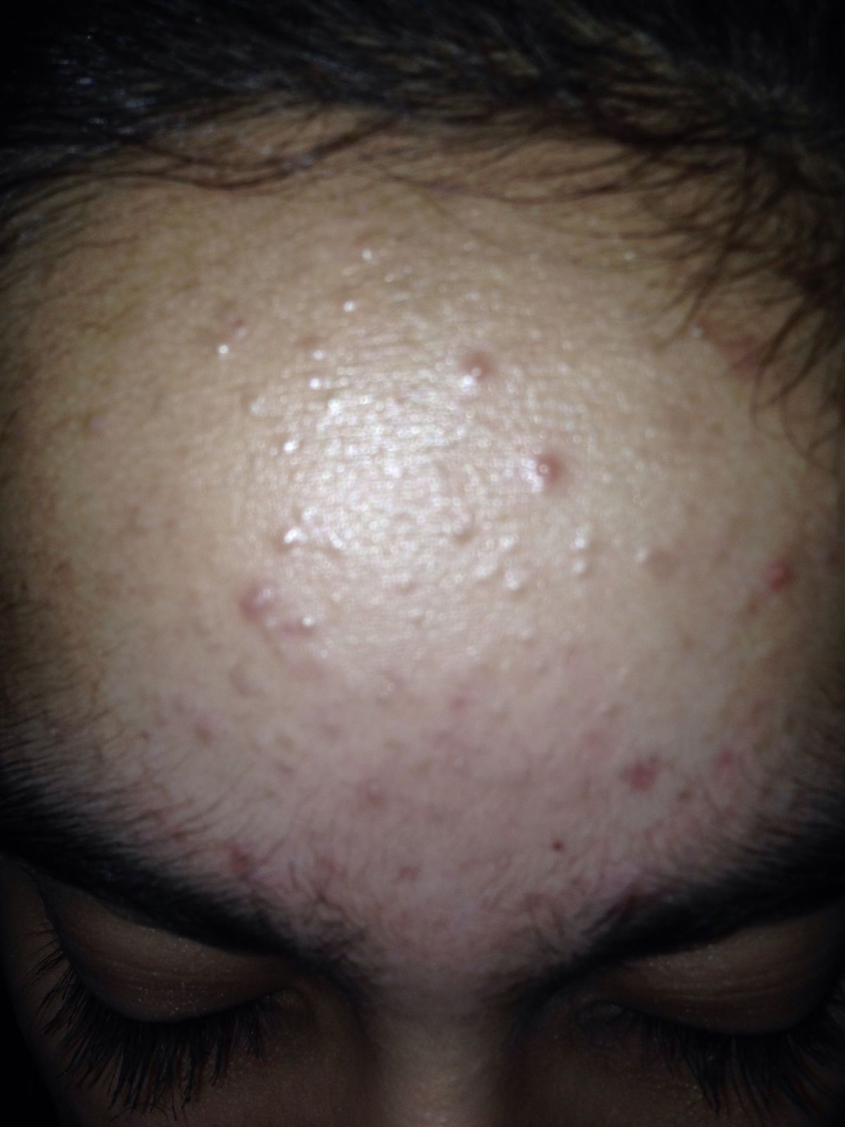 Red Bumps On Face