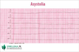 Asystolia