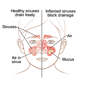 Sinusitis In Children