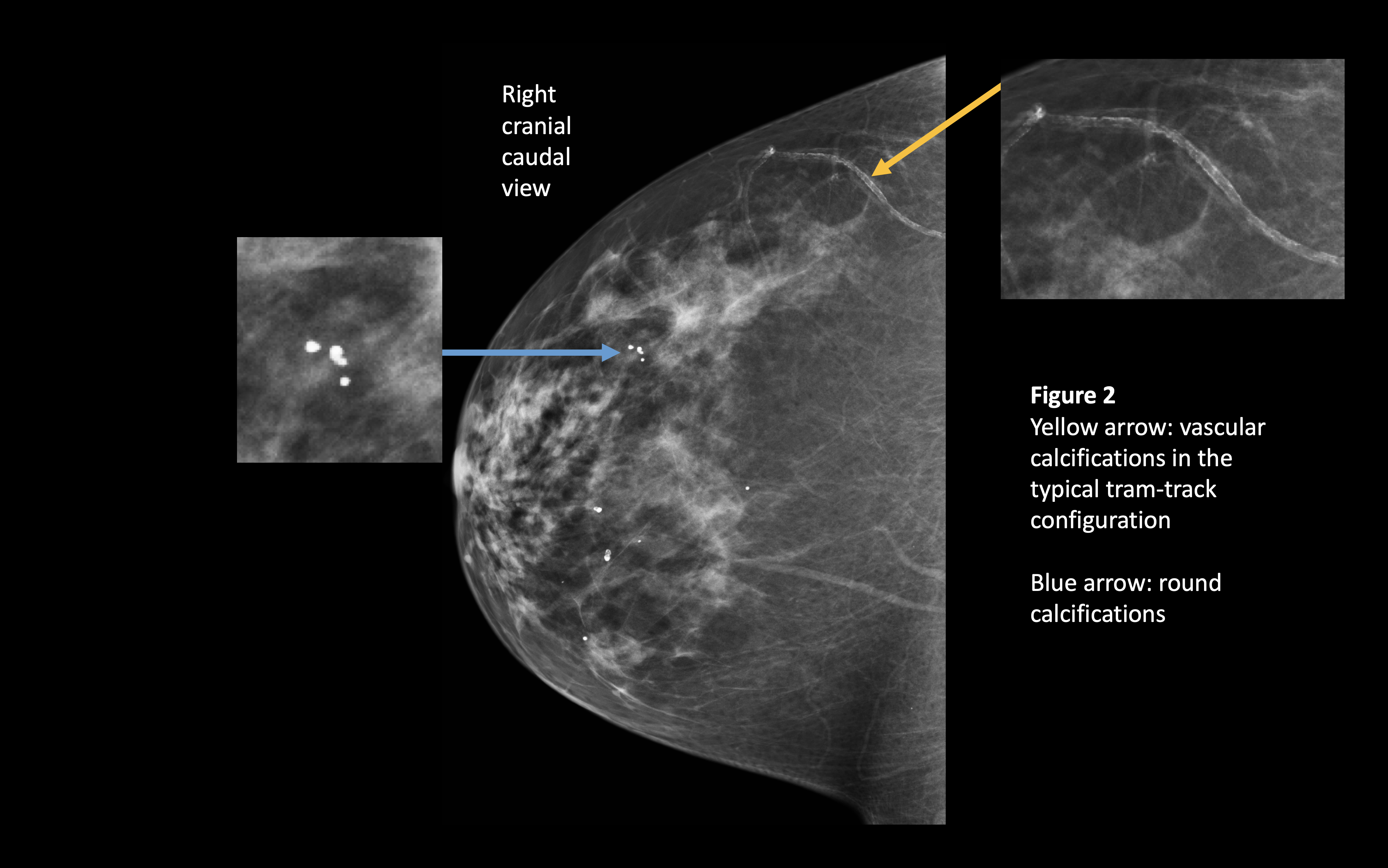 Benign Breast Calcifications | Treatment & Management | Point of Care