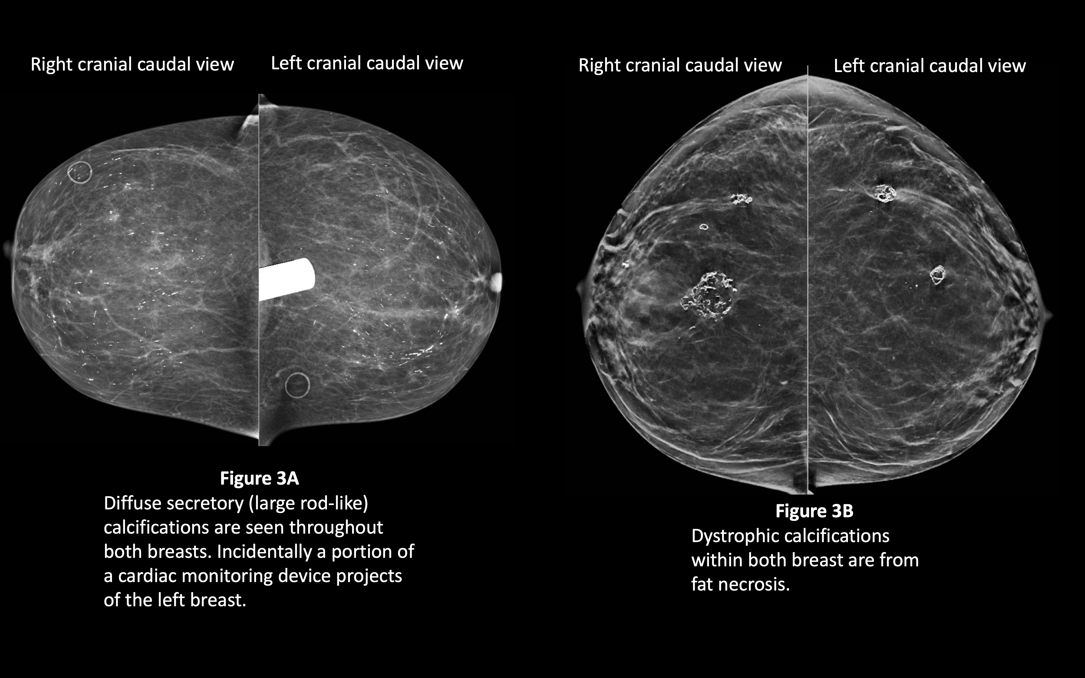 Benign Breast Calcifications | Treatment & Management | Point of Care