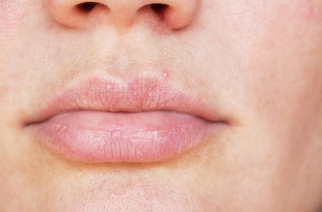 White Bumps on Lips