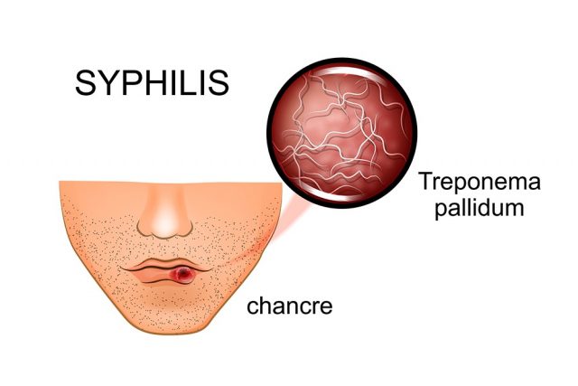 Chancre: Syphilis symptoms