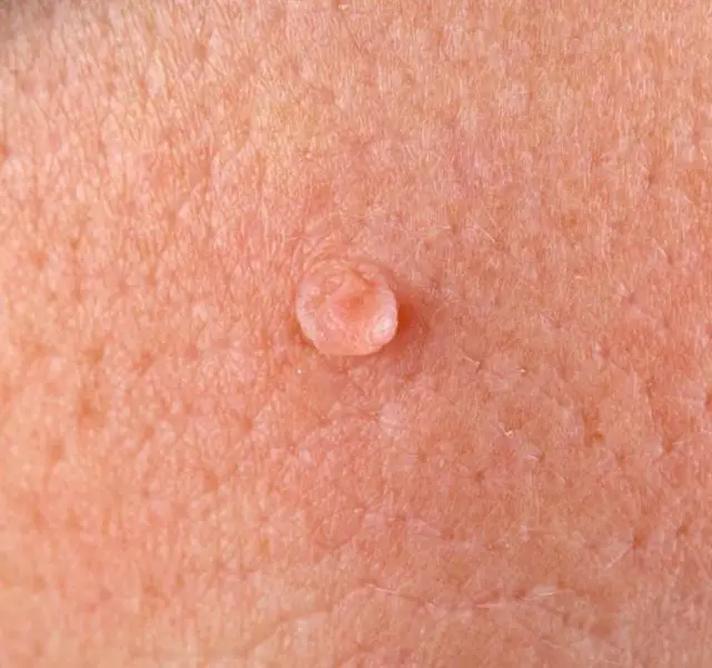 Close up photo of wart on human skin