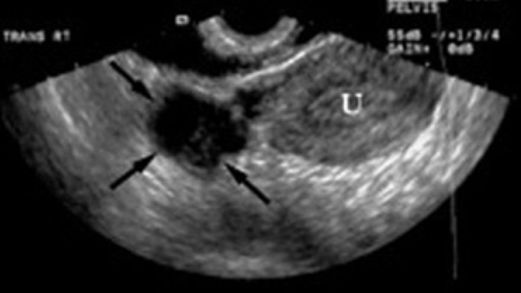 Pelvic Inflammatory Disease Ultrasound