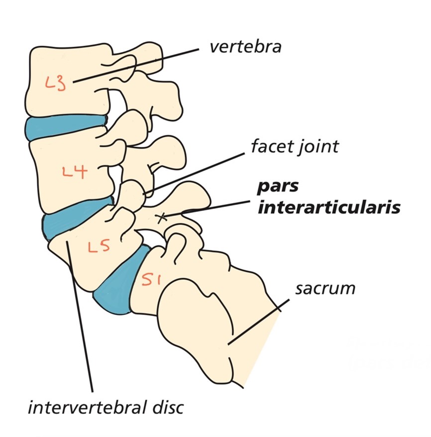 St Peter's College - Understanding PARS Syndrome