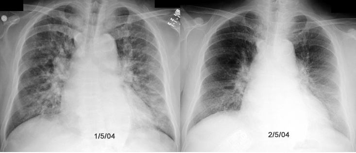 Rapid changes in CXR : CXR can dramatically change in CHF rapidly as in ...