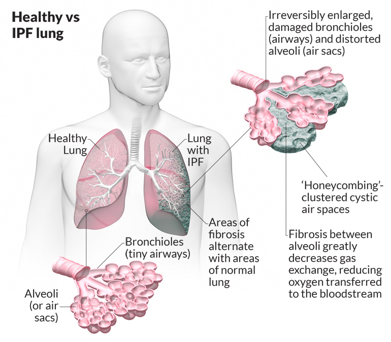 Applied Abnormalities in Cardiopulmonary physiology with COPD | Strive ...