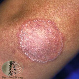 Tinea Treatment - Ringworm - Colorado Springs & Monument, CO