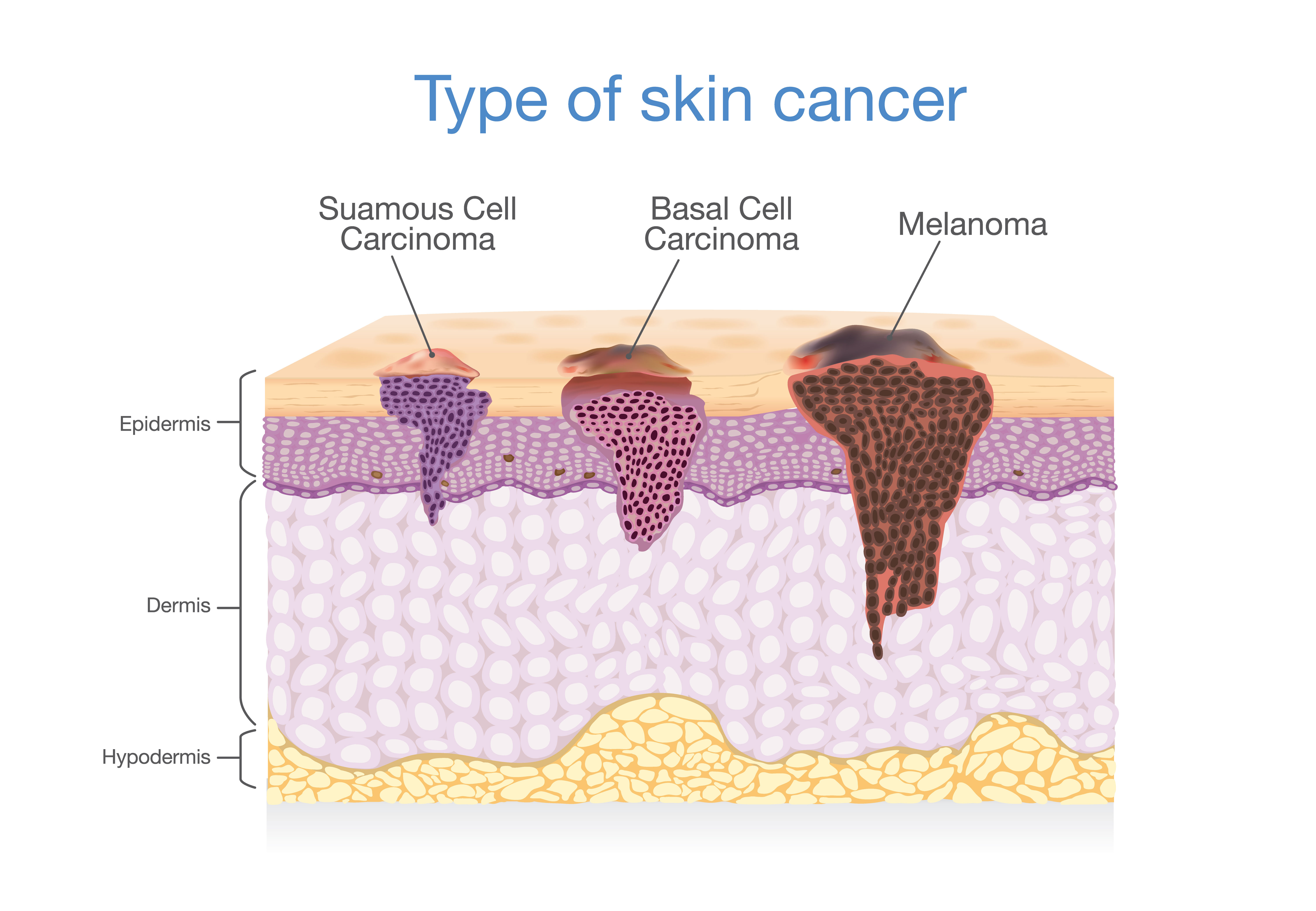 Ma dai! 13+ Fatti su Melanoma Skin Cancer Images Nhs? Dermatologist ...