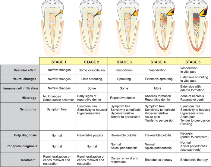 Referred Tooth Pain Chart