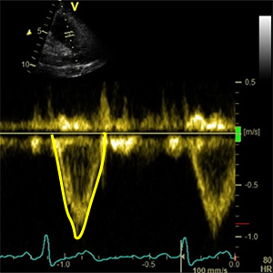 RVOT VTI (Velocity time integral of right ventricular outflow tract)