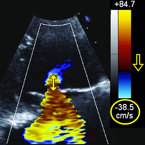 Tricuspid valve PISA and alising velocity