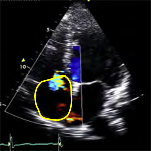 RA area (Right atrial area)