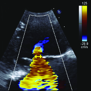 Tricuspid valve VCW (Vena contracta width)