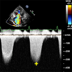 Vmax TR (Peak tricuspidal regurgitation velocity)