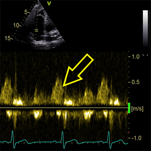 Dominant tricuspidal A wave (A wave > E wave)