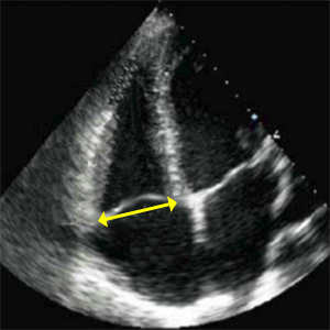 TV annulus (Tricuspid valve annulus diameter)