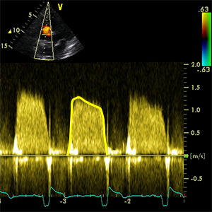 VTI TV (Velocity time integral of tricuspid valve - inflow)