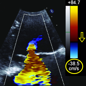 Tricuspid valve Va (Aliasing velocity)