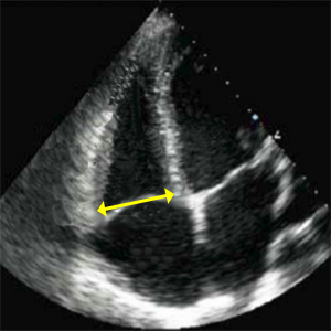 RVD1 basal (Right ventricular basal diameter at end-diastole)