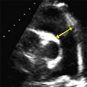 RVOT diastal (Right ventricular outflow tract dimension at distal)