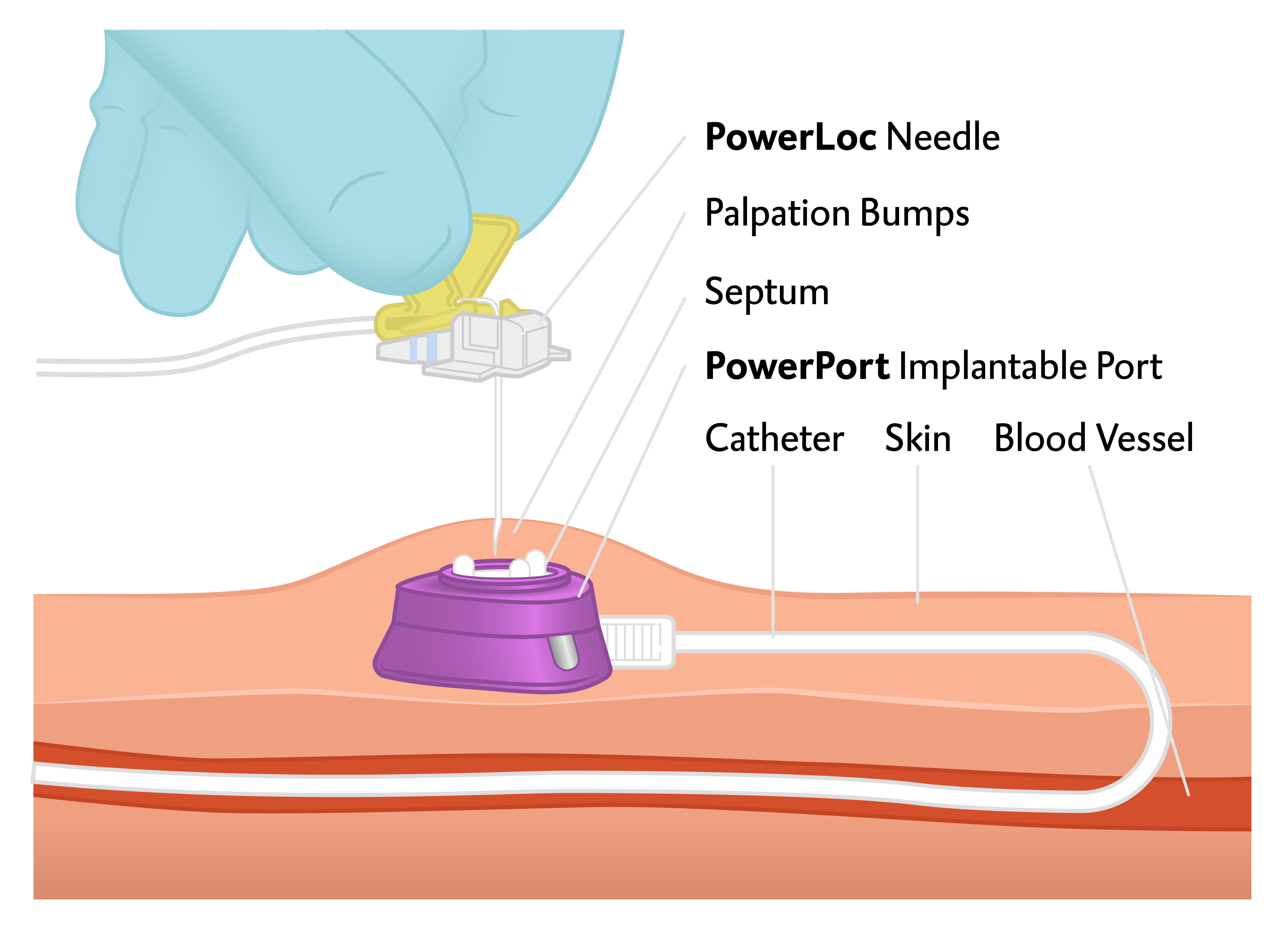 Port A Cath Catheter