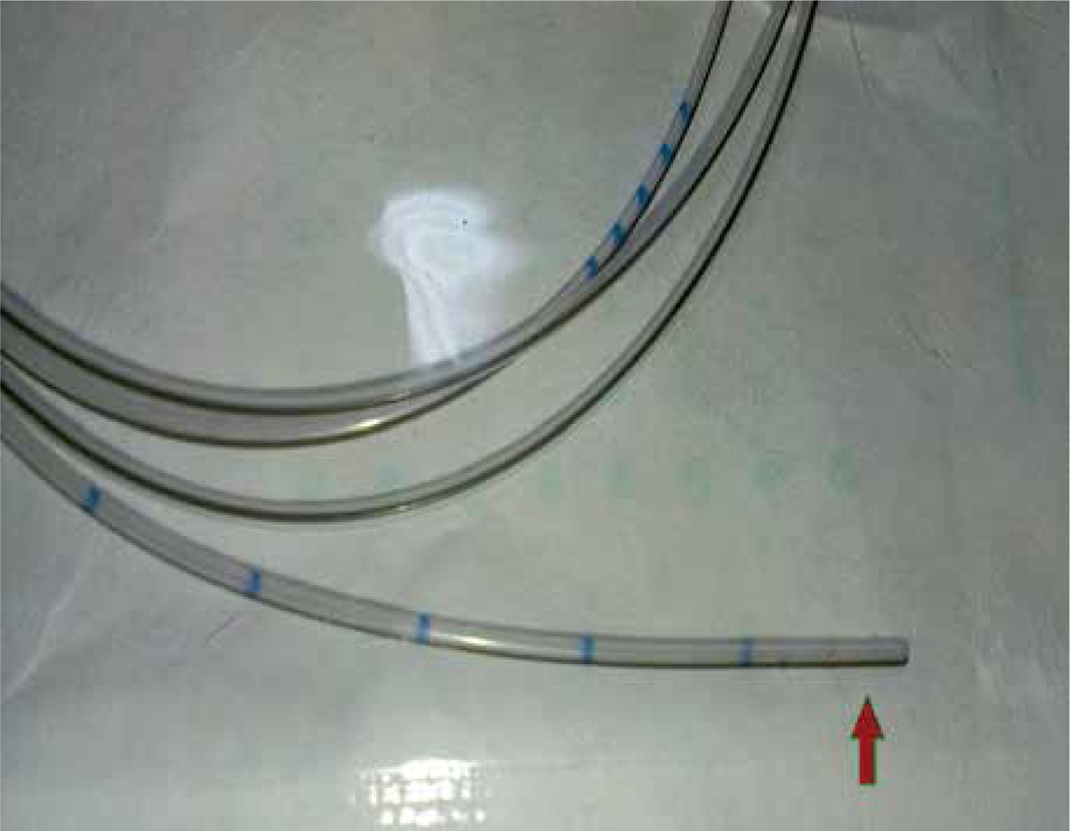 Sialendoscopy-assisted intraoral incision approach for the treatment of ...