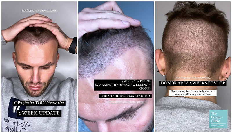 Hair Restoration Recovery