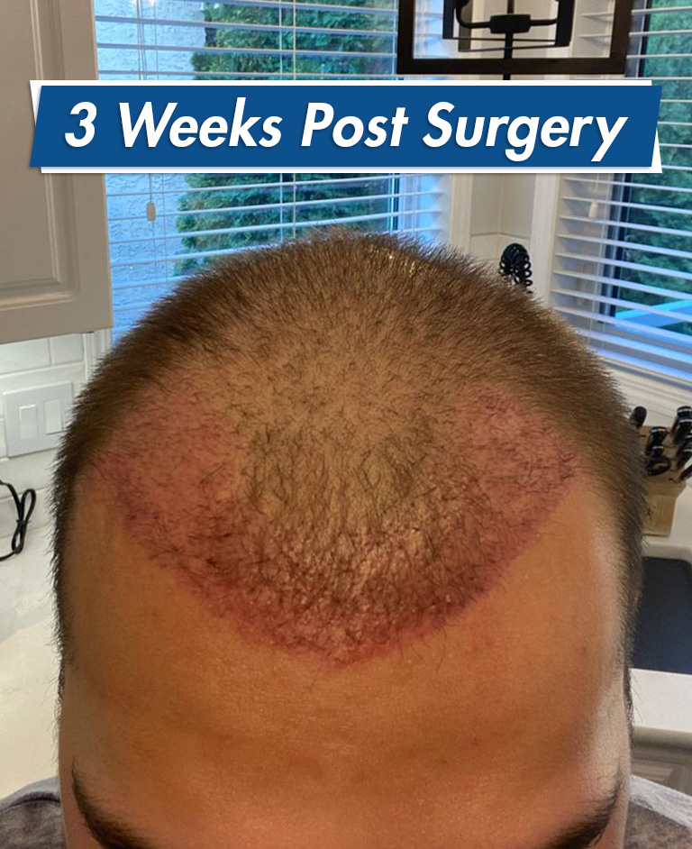 Hair Restoration Recovery