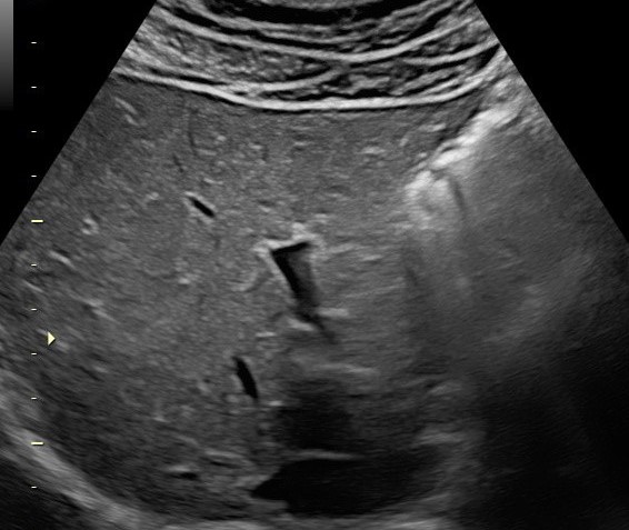 Normal Vs Fatty Liver Ultrasound