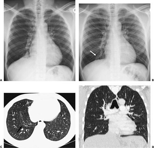 Pleura, Chest Wall, and Diaphragm | Thoracic Key