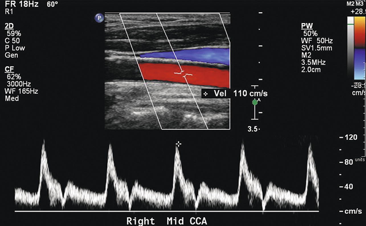 Carotid Ultrasound Waveforms