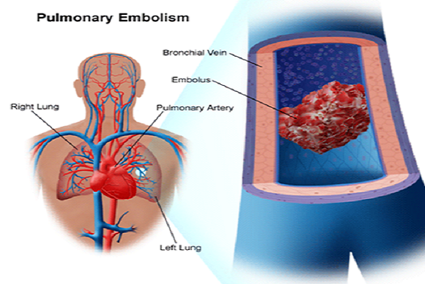 blood clot in lung