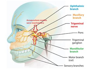 Somatic Pulsatile Tinnitus / Normal Tinnitus and Acupunture | Tinnitus ...