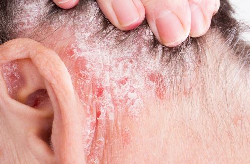 Flaky Skin behind Ear