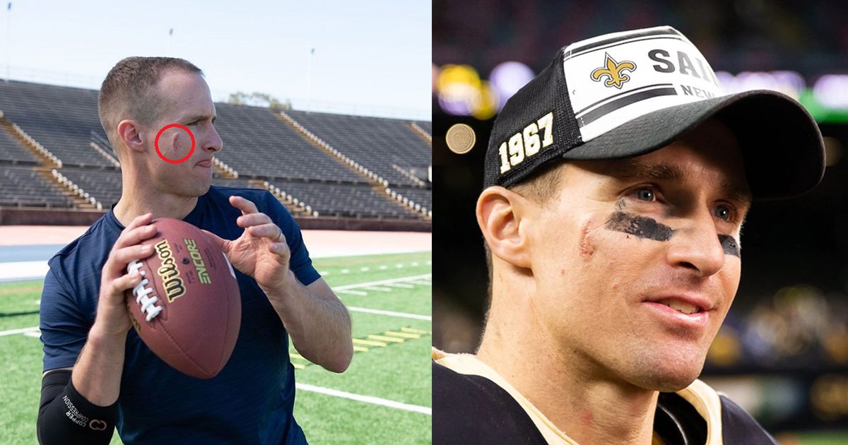 The Real Story Behind Drew Brees’ Scar Revealed