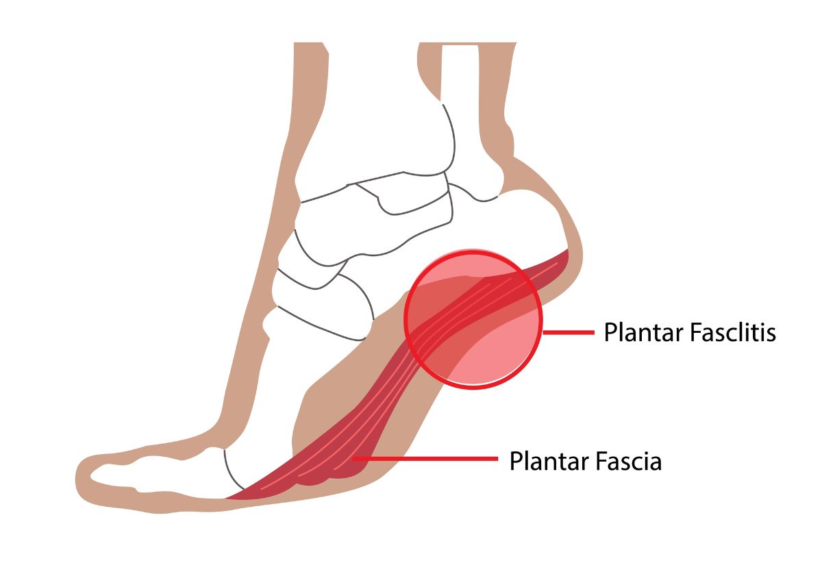 foot diagram of plantar fasclitis