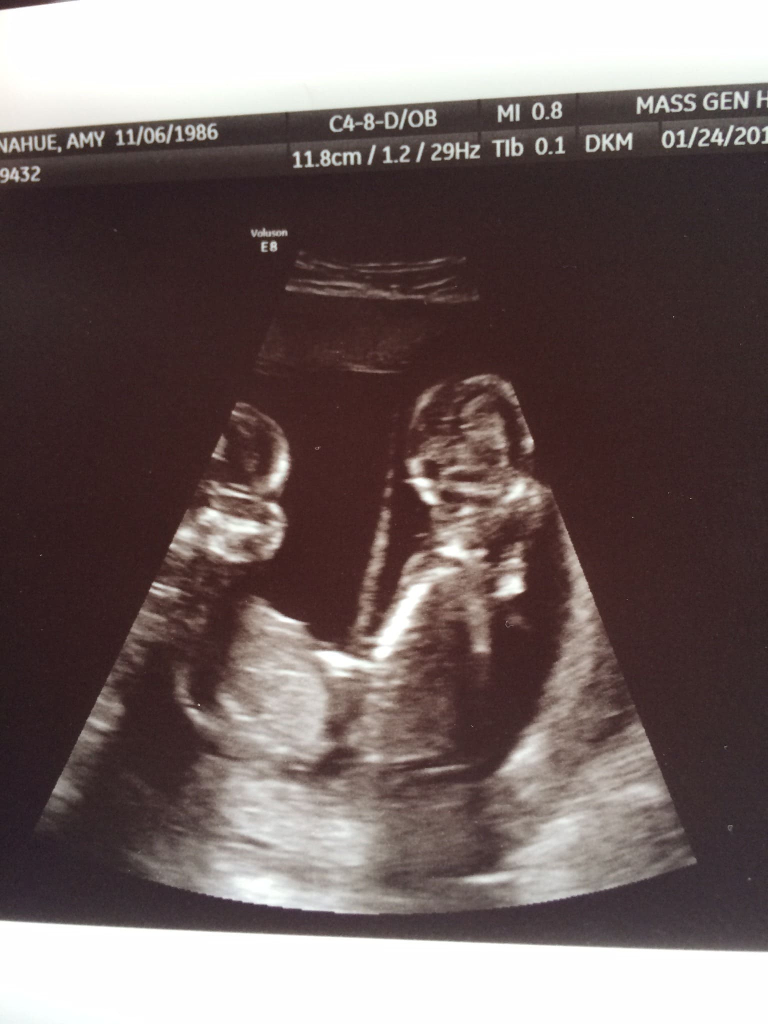 Ultrasound Twins 16 Weeks