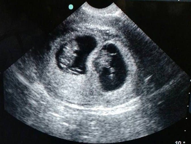 Twin Ultrasound 8 Weeks