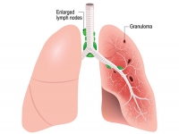 Big-data helps define the burden of sarcoidosis