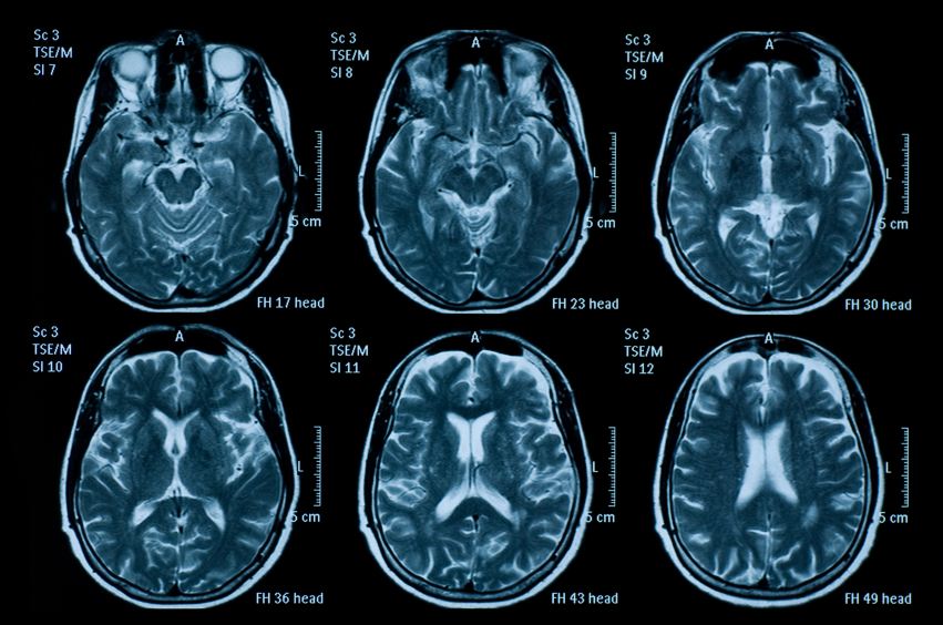 Brain Scans Mri