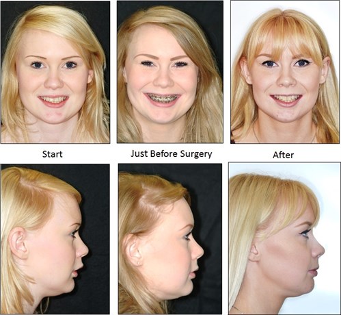 Corrective Jaw Surgery Class II