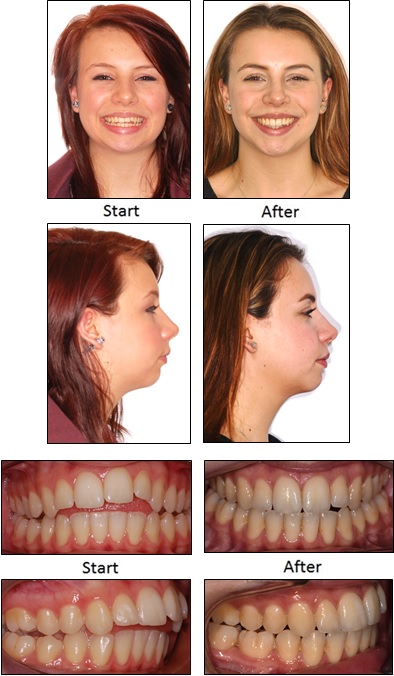 Corrective Jaw Surgery - AOB