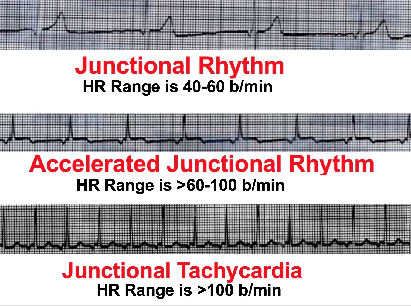 Junctional Tachycardia